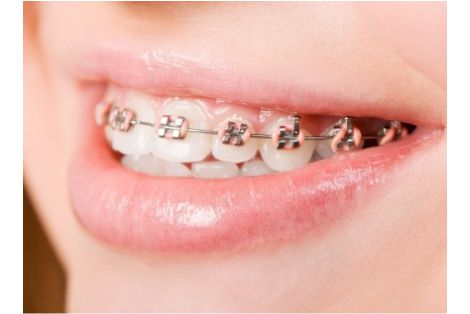 Orthodontic Treatment